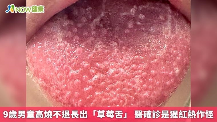 9歲男童高燒不退長出「草莓舌」 醫確診是猩紅熱作怪