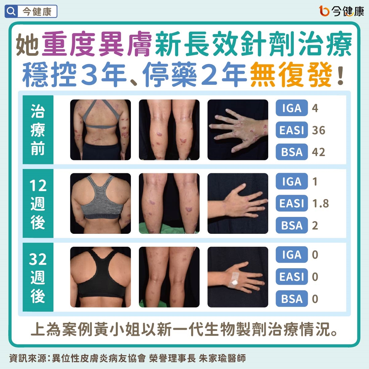 #異膚 #異位性皮膚炎 #朱家瑜 #黃毓惠