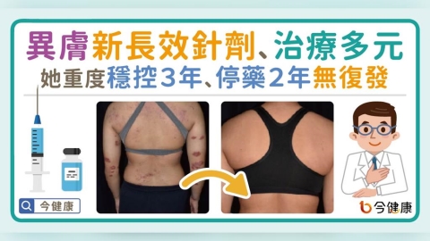 異膚新長效針劑與多元治療！她重度穩控３年、停藥２年無復發