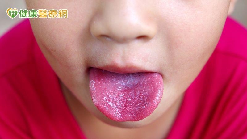 9歲童連燒不退伴隨草莓舌！醫：猩紅熱初期常被誤當感冒