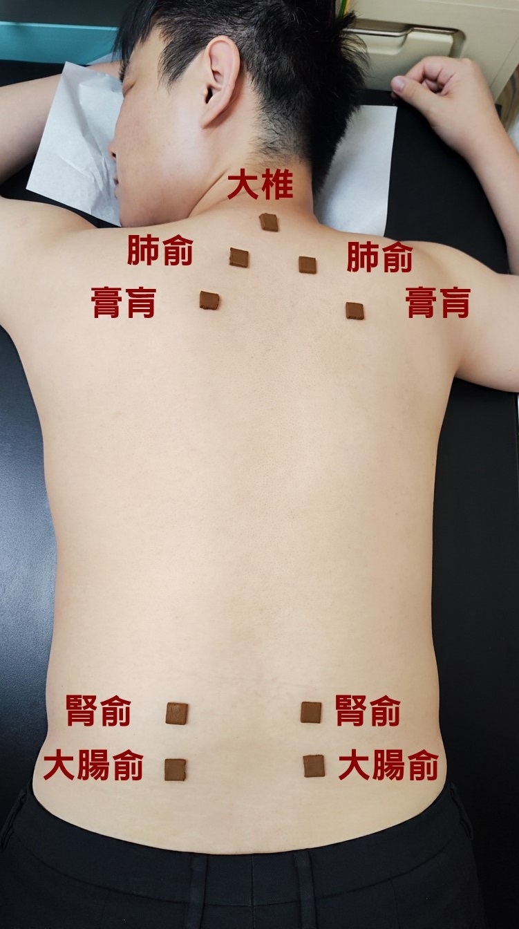 熱在三伏貼！中醫貼敷「大椎、肺俞、腎俞」穴位！提升自體免疫