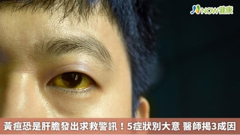 黃疸恐是肝膽發出求救警訊！5症狀別大意 醫師揭3成因