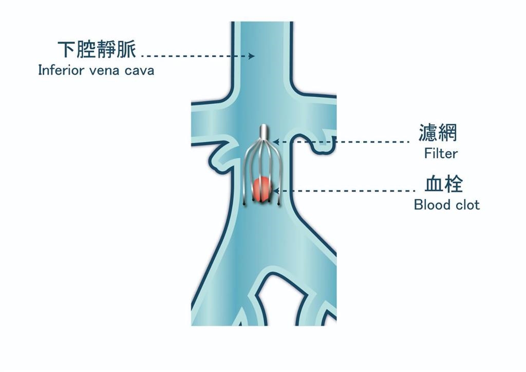 被忽視的靜脈殺手！醫談深層靜脈栓塞