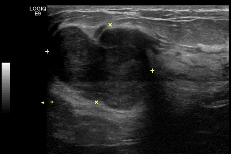 乳房良性葉狀瘤勿輕忽 內視鏡微創完整切除重建保健康
