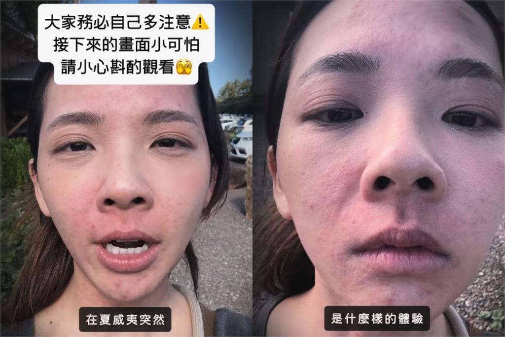 滴妹飛夏威夷做「1件事」大過敏！紅疹爬滿身「近距離爛臉照」嚇壞眾人