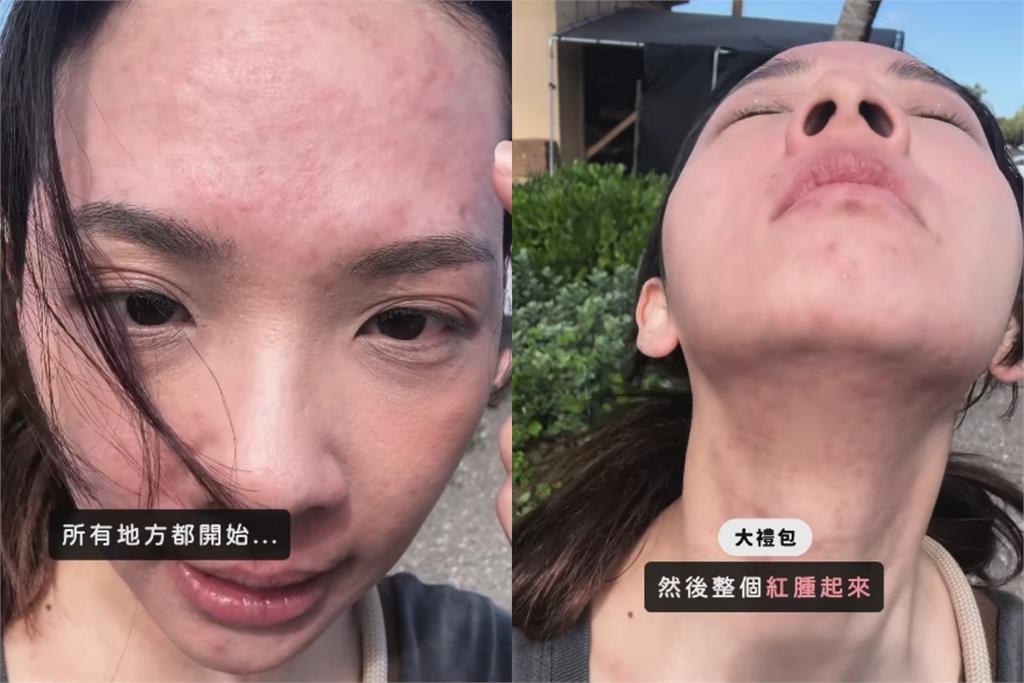 滴妹飛夏威夷做「1件事」大過敏！紅疹爬滿身「近距離爛臉照」嚇壞眾人