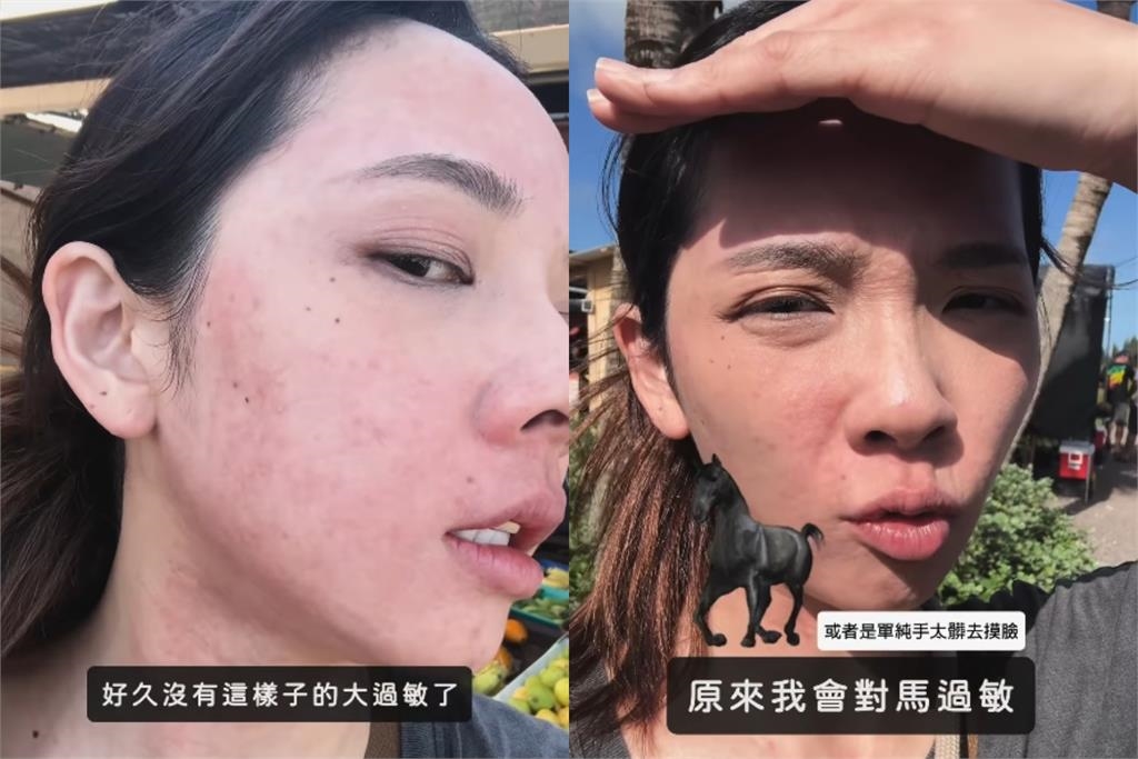 滴妹飛夏威夷做「1件事」大過敏！紅疹爬滿身「近距離爛臉照」嚇壞眾人