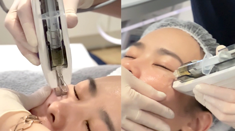 夏季抗痘全攻略！ 皮膚科醫師揭控油、治療、修復關鍵