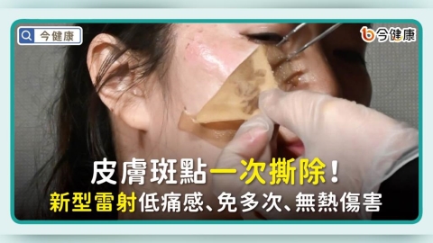 皮膚斑點一次撕除！新型雷射低痛感、免多次、無熱傷害成趨勢