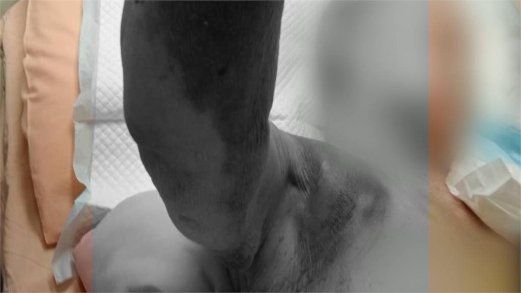 94歲老母親無故大面積瘀青　女兒不捨疑遭不當對待