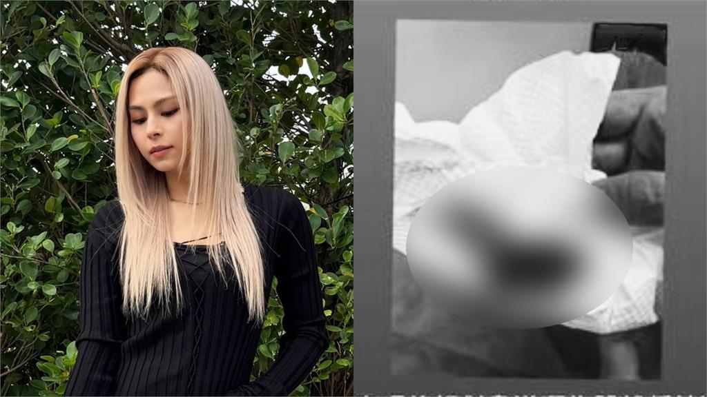 女星疑病倒曬「拔罐染血紙巾照」!昔窮到剩1000元嘆:慶祝我還有生命 女星疑病倒曬「拔罐染血紙巾照」!昔窮到剩1000元嘆:慶祝我還有生命