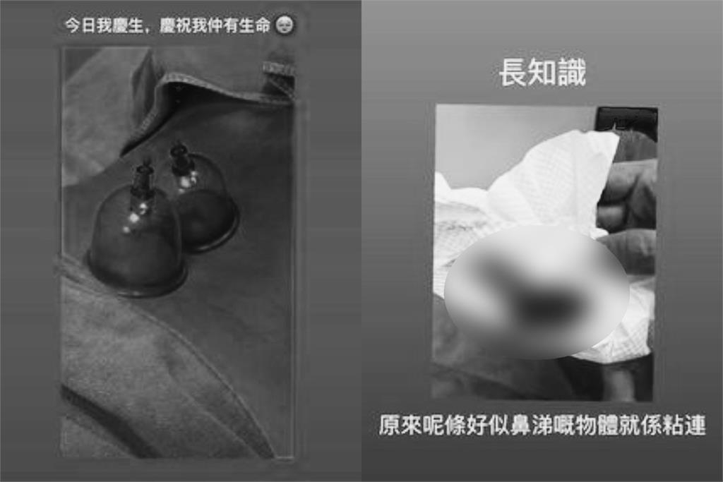 女星疑病倒曬「拔罐染血紙巾照」!昔窮到剩1000元嘆:慶祝我還有生命