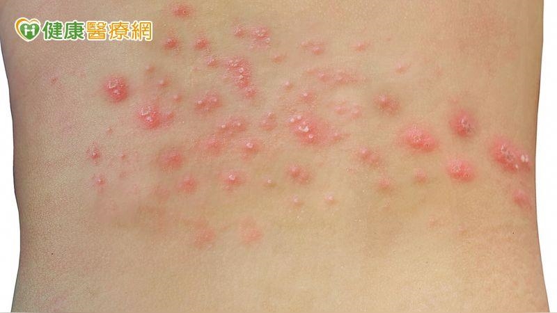 得過帶狀疱疹也可能再復發 醫籲:疫苗接種是防治關鍵 得過帶狀疱疹也可能再復發 醫籲:疫苗接種是防治關鍵