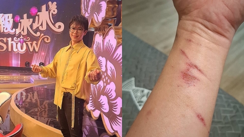 《冰冰Show》班底被冷凍後重返舞台! 突曬手傷照訴心聲:都只是過程