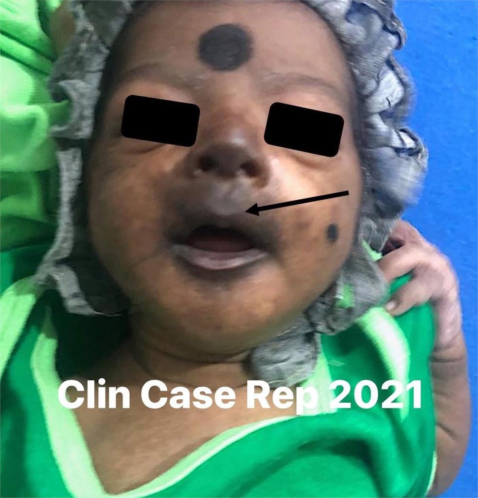 嬰兒染屈公病「臉部發黑」畫面　醫揭8大症狀「無特效藥」：恐肝衰竭