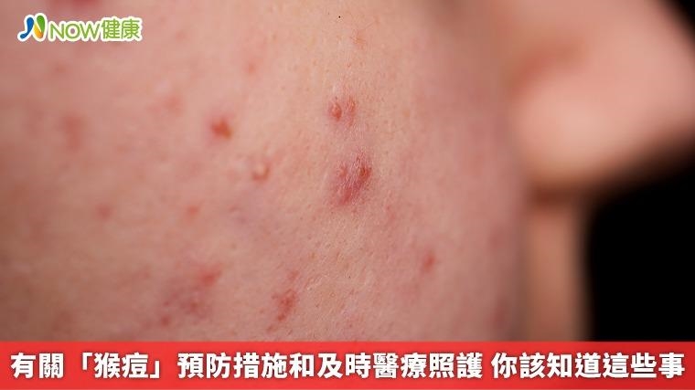 有關「猴痘」預防措施和及時醫療照護 你該知道這些事