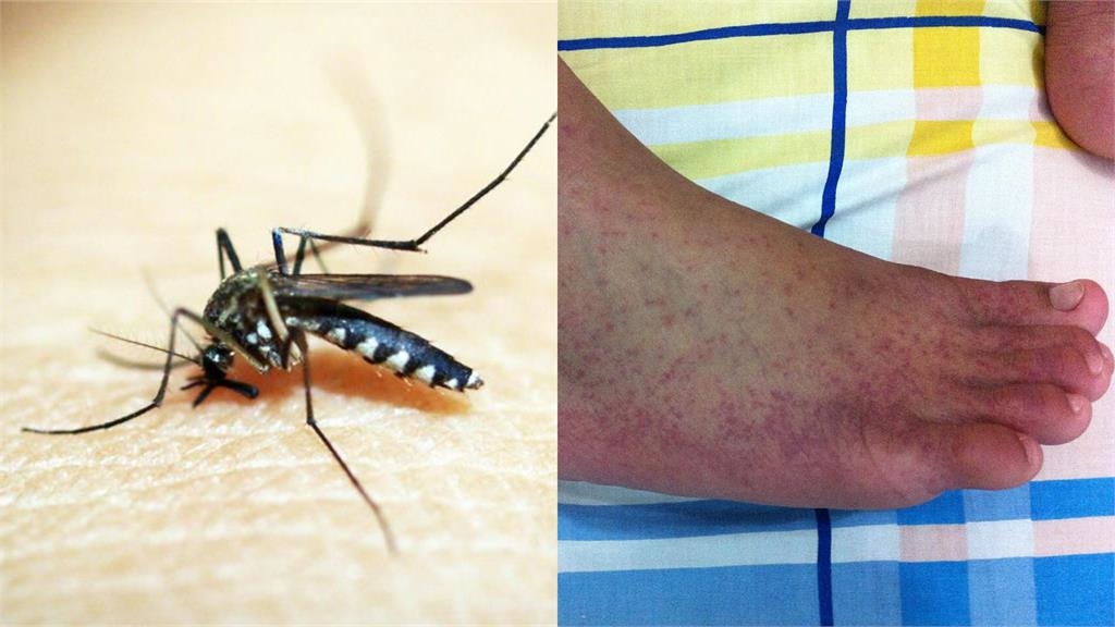 都是由病媒蚊散布⋯屈公病≠登革熱！「這症狀」恐讓你痛到無法行動