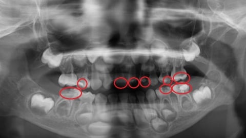 牙齒塗氟沒有用?!兒童乳牙蛀牙變蜂窩性組織炎!醫揭5大護齒關建