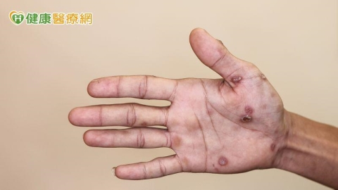 梅毒病例上升7%！疾管署推匿名諮詢與臨床指引　盼降低性傳染病風險
