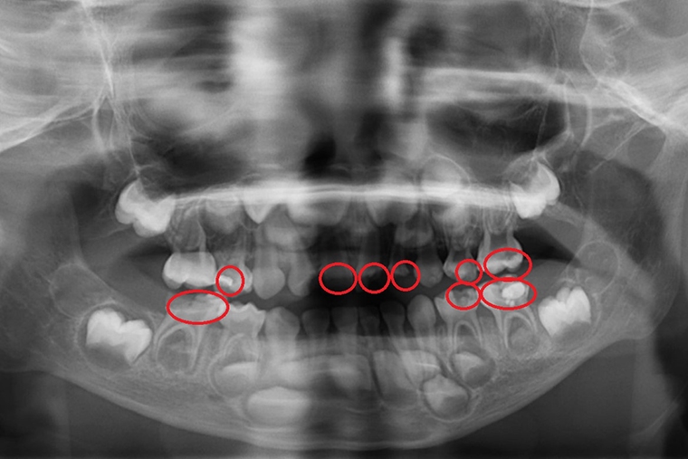 5歲童乳牙蛀牙變蜂窩性組織炎 牙醫師傳授5大護齒關鍵