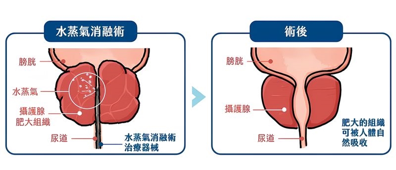 攝護腺肥大治療新選擇 微創手術助擺脫排尿不順之苦