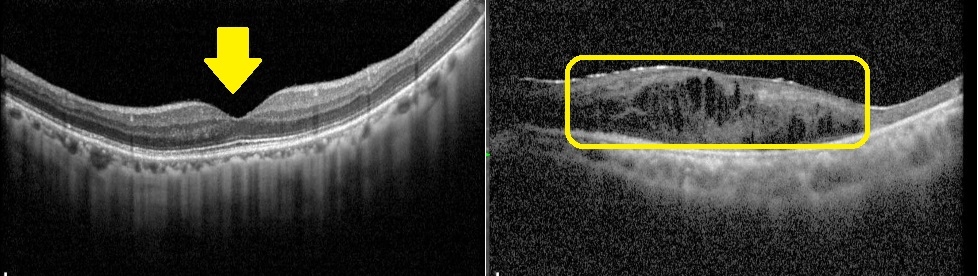 黃斑部病變險奪光明　長者視力惡化別輕忽