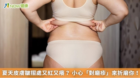 夏天皮膚皺摺處又紅又癢? 小心「對磨疹」來折磨你!
