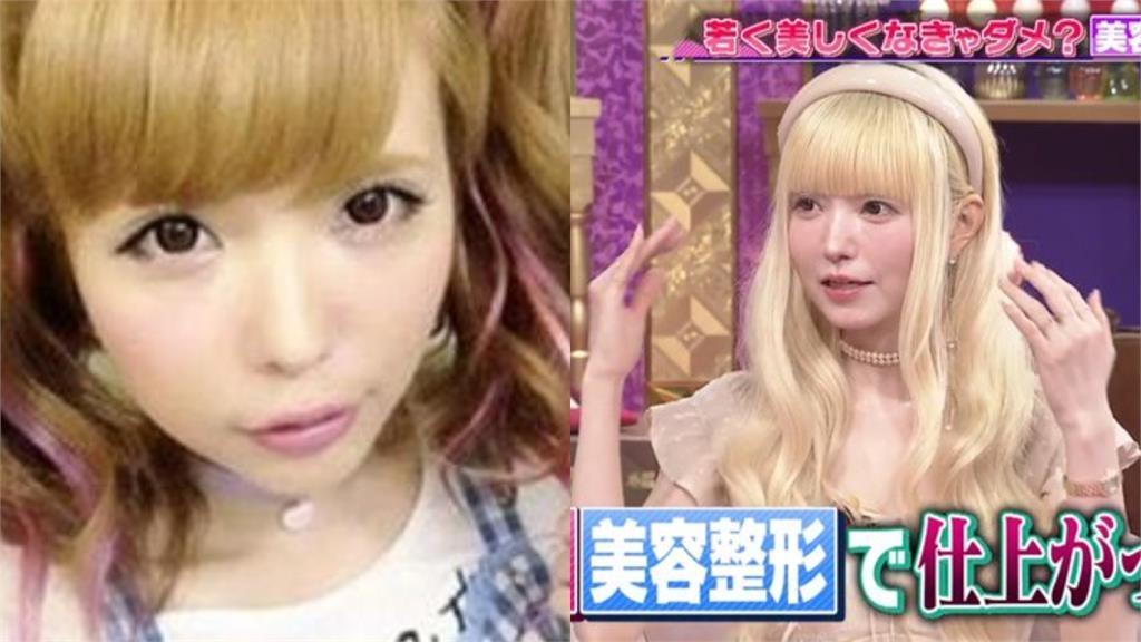 日本「洋娃娃系」名模昔追V臉瘋狂醫美！「溶解玻尿酸」整臉爆改驚人樣貌曝