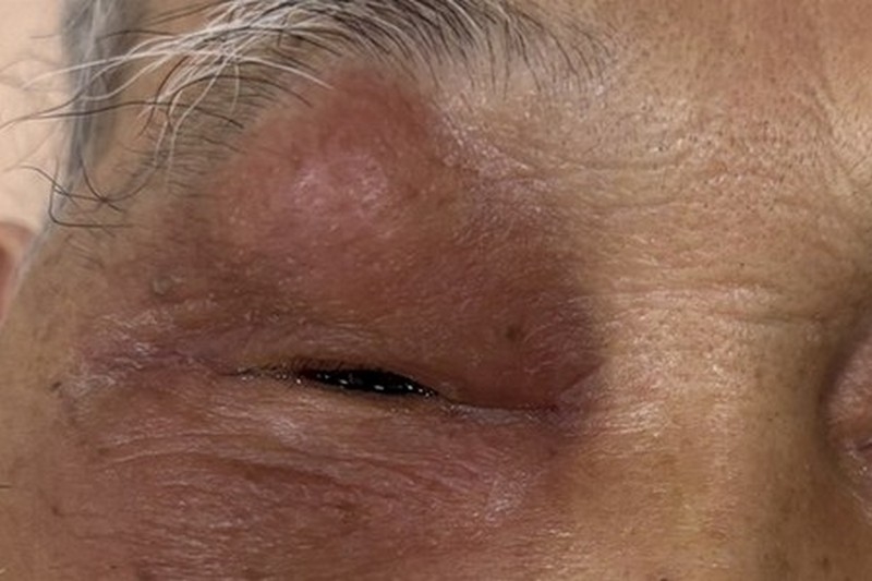 急性鼻竇炎引發眼睛腫!?鼻塞、分泌物靠「這招」解除病灶!