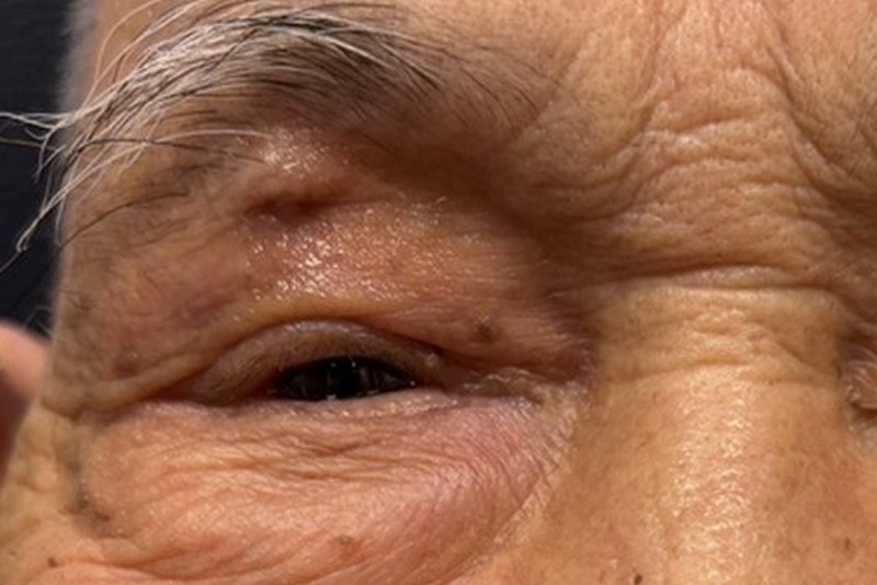 急性鼻竇炎引發眼睛腫!?鼻塞、分泌物靠「這招」解除病灶!