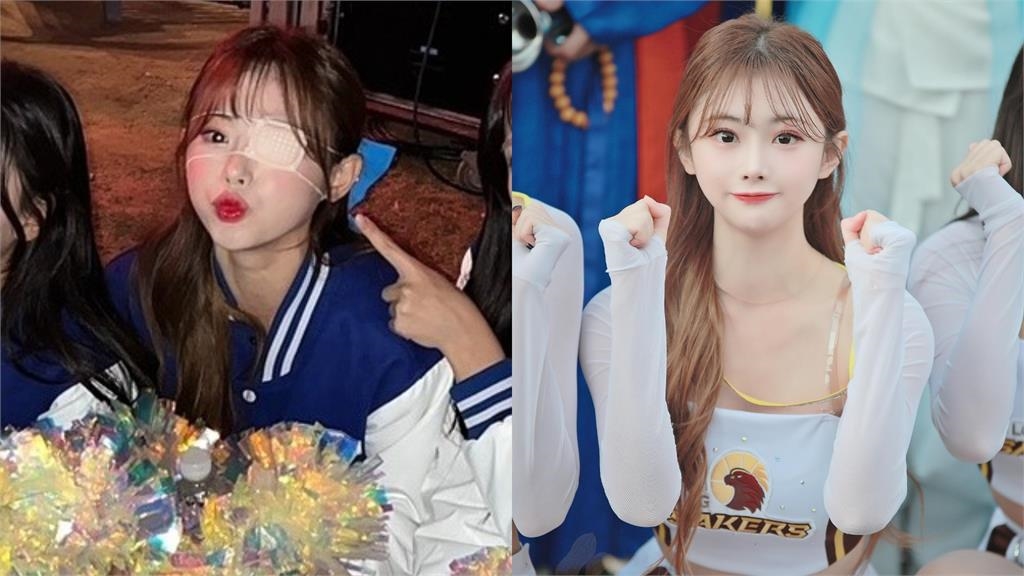 金娜妍1天只睡2小時出事了！眼睛長皮蛇「發高燒+全身痛」嘆：恐永久留疤