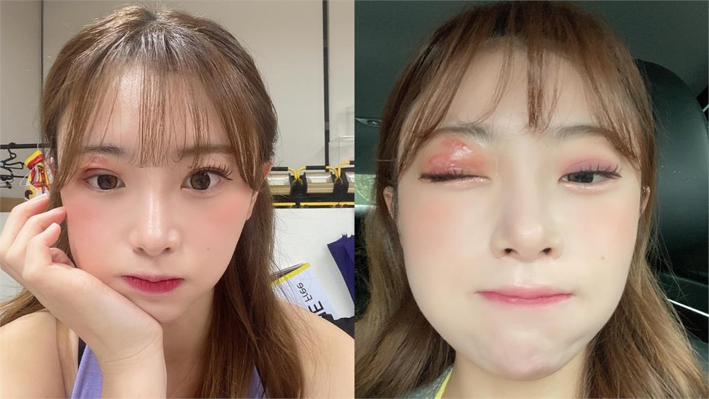 金娜妍1天只睡2小時出事了！眼睛長皮蛇「發高燒+全身痛」嘆：恐永久留疤