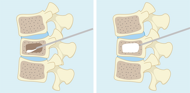 骨質疏鬆致骨折！ 骨水泥灌注手術有助重塑骨骼支撐力 
