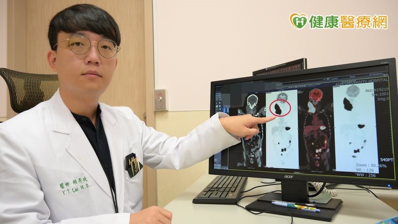 六旬翁頸部腫塊瞬間長成「鴕鳥蛋」 確診罕見伯基特淋巴瘤險奪命