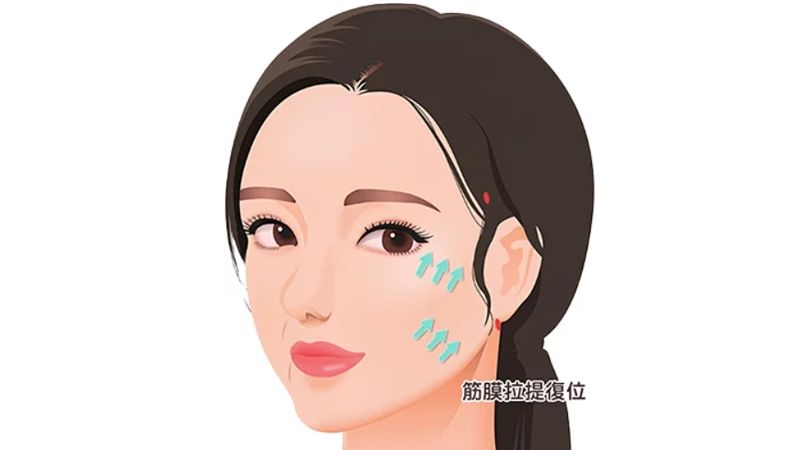 想拉皮抗老化又怕疤痕與術後腫脹?「筋膜拉提」主打隱痕小切口受關注