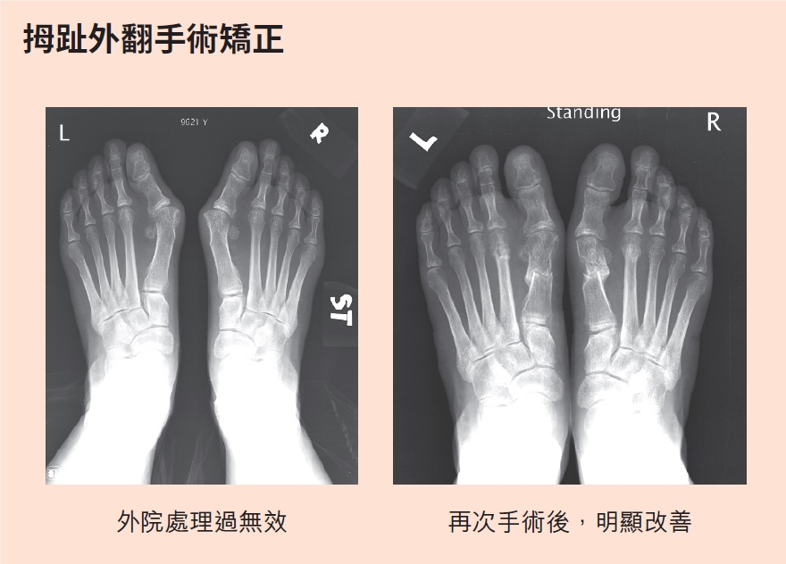 扭傷喬一喬就會好？ 醫：急救關鍵5步驟必學，處理不當恐「數十年站不穩」