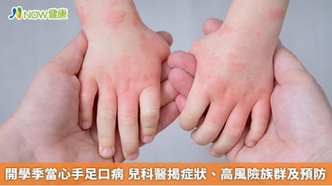 開學季當心手足口病 兒科醫揭症狀、高風險族群及預防