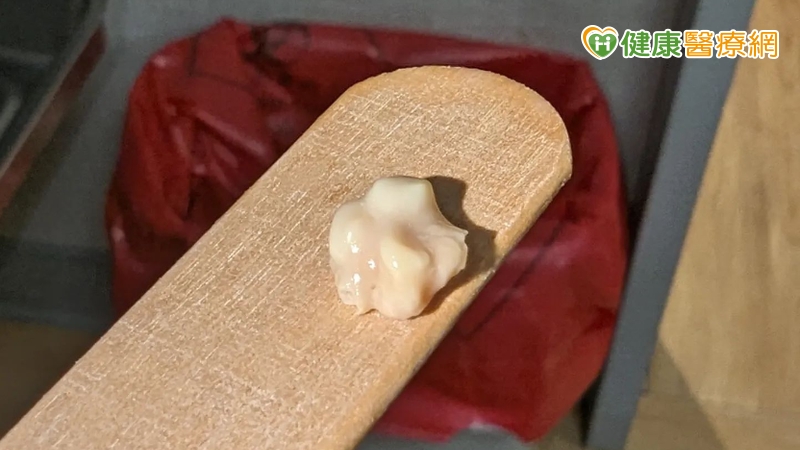 又軟又臭的白色渣渣卻叫扁桃腺「結石」？醫師來解密！4點徵兆自我判斷