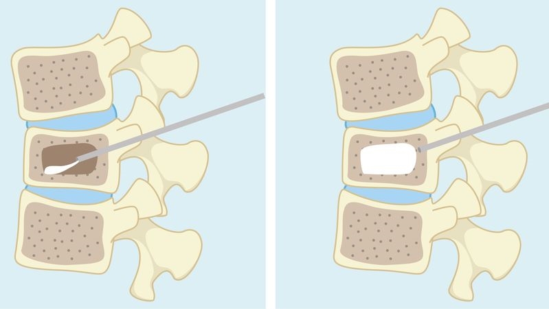 背痛別拖!醫曝「骨質疏鬆警訊」 一聲「喀」就可能骨折
