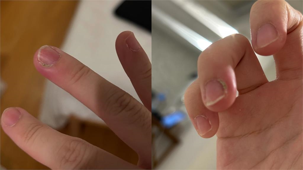 百萬YTR HOOK翻「超臭老書」突冒膿包！奔歐洲醫院「整根發黑」來不及了...