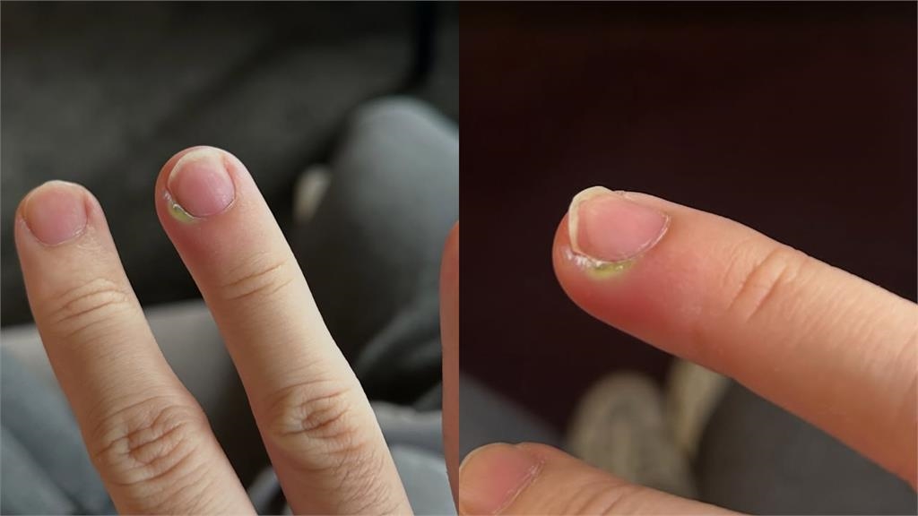 百萬YTR HOOK翻「超臭老書」突冒膿包！奔歐洲醫院「整根發黑」來不及了...