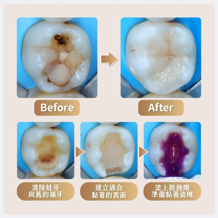 瓷塊補牙不只美觀 同時兼顧「保護牙齒」延長真牙壽命