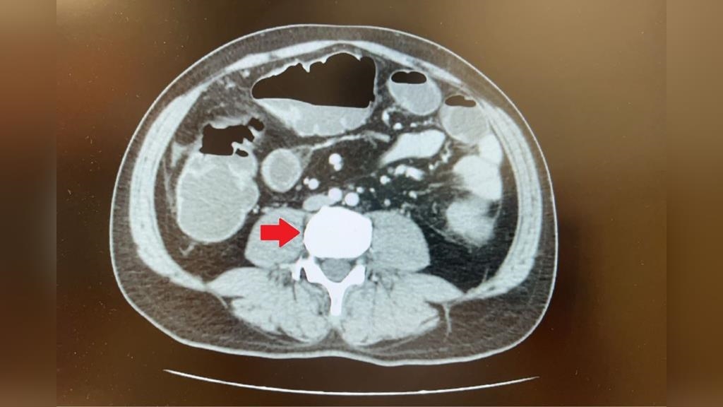 肚脹三天未排便驚見大腸癌阻塞！「5大惡習」恐釀大腸病變