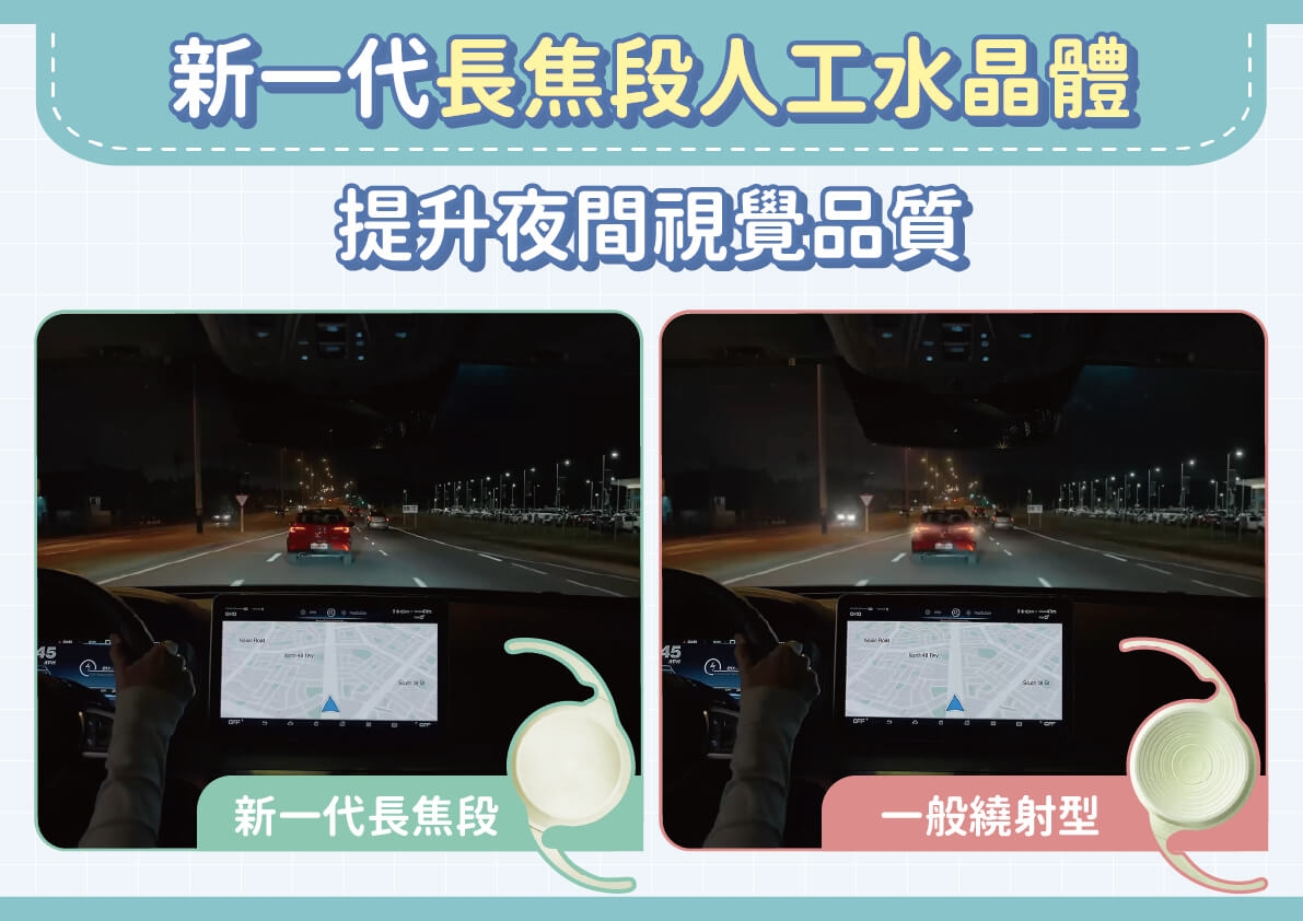 白內障術後重拾安心「視」界！飛秒雷射＋新一代長焦人工水晶體來幫忙