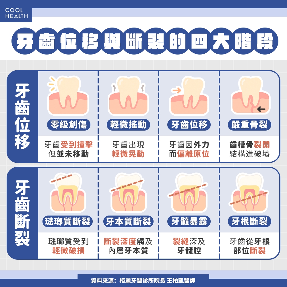 整排牙齒連骨頭一同位移！ 醫揭牙齒位移、斷裂四大分級