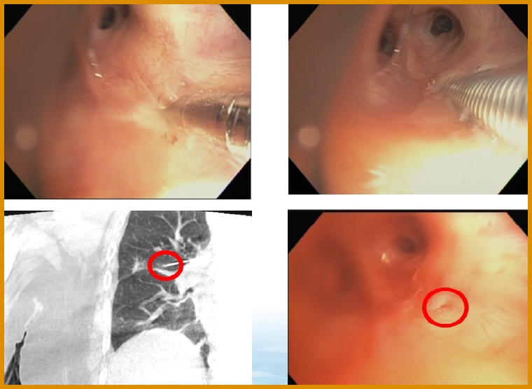 三總肺癌治療新突破! 精準診斷定位同步切除肺小結節