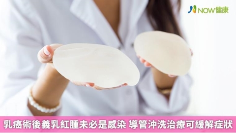 乳癌術後義乳紅腫未必是感染 導管沖洗治療可緩解症狀 