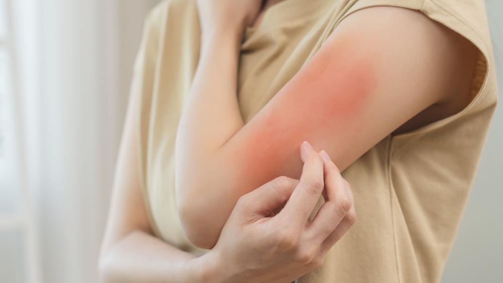 異位性皮膚炎「根治迷思」讓病友身心俱疲！ 醫示警：花大錢用偏方恐得不償失