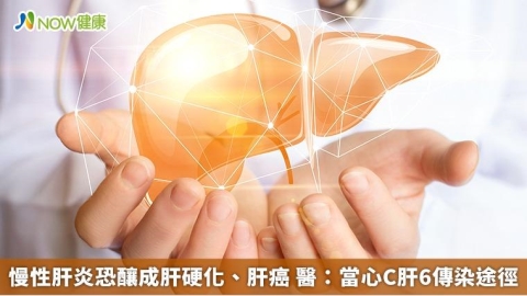 慢性肝炎恐釀成肝硬化、肝癌 醫:當心C肝6傳染途徑