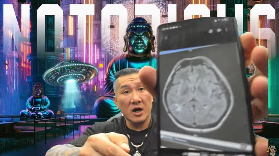 館長直播曬X光片自曝「腦有問題」！這1部分消失「驚見白色塊狀物」險癱瘓